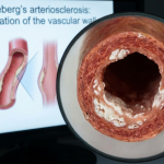 Mönckeberg's arteriosclerosis