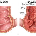 healthy colon vs inflamed colon